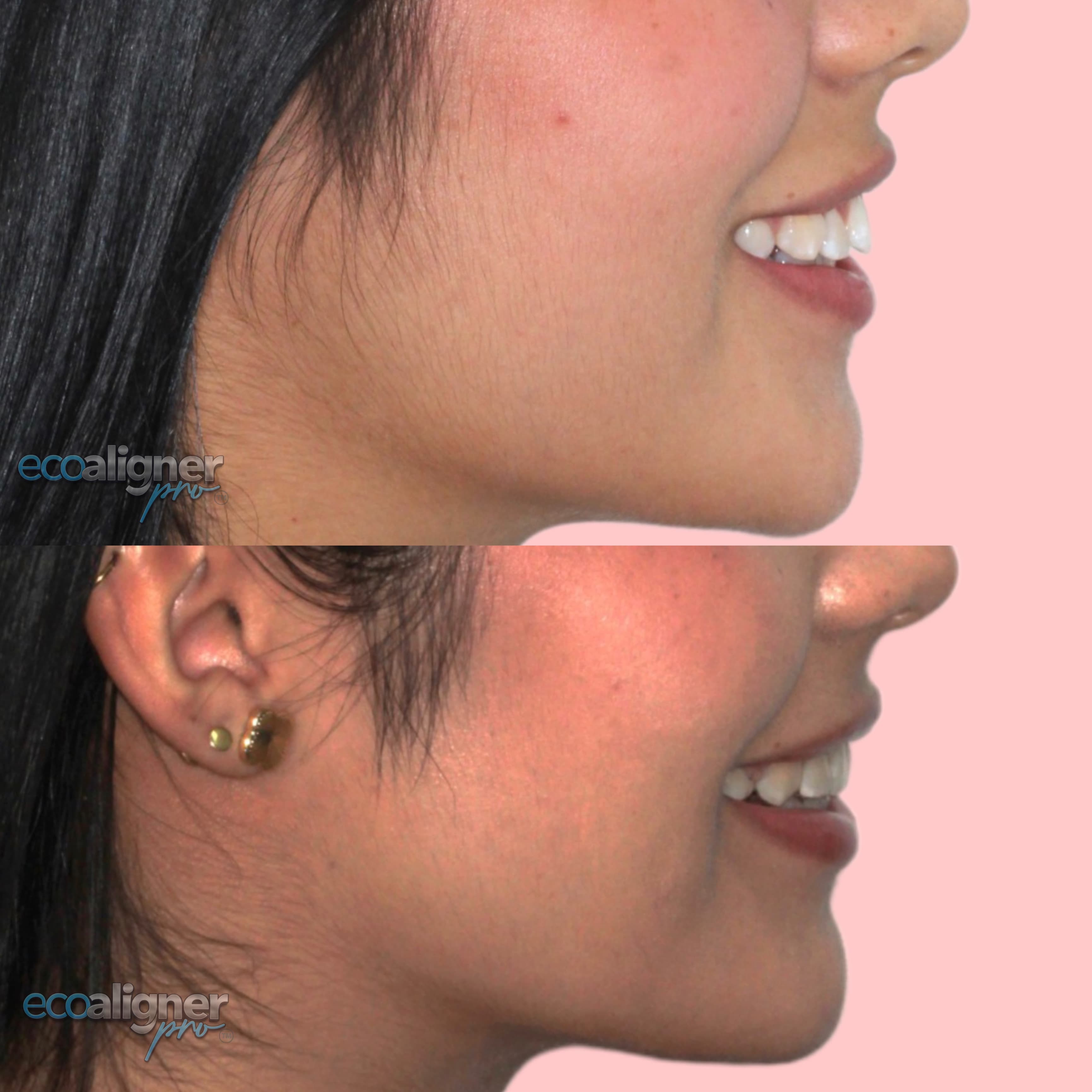 Dos fotografías apiladas del mismo caso, tomadas de perfil: arriba, el perfil y los dientes antes del tratamiento; abajo, el mismo perfil al terminar.